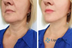 Double chin before and after Hi-Fu treatment 4 Book your double chin treatment Purfleet today! We are here to help!