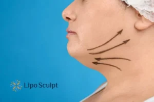 Double chin before and after Hi-Fu treatment 3 Boost your confidence with a Double chin treatment Purfleet
