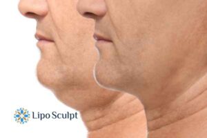 Double chin before and after Hi-Fu treatment 2 Double chin treatment Purfleet from Lipo Sculpt - feel more confident today!