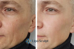How to Fight Aging Symptoms 3 Fight Aging Symptoms Purfleet With HIFU and Morpheus8 Today!
