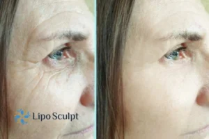 How to Fight Aging Symptoms 2 Do you want to Fight Aging Symptoms Purfleet? Contact Lipo Sculpt today!