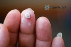 Cryopen Top 5 Treatable Conditions 4 Do you have a persistent wart of verruca that you cannot shit? Cryopen Purfleet treatment will work call us NOW!