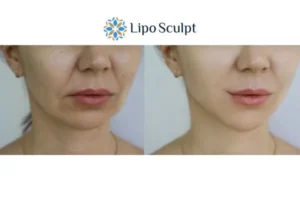 Explaining Total Skin Tightening Treatment And What It Can Do For You 2 Do you want to boost your self confidence? Give Morpheus8 Purfleet a try today!