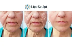 Explaining Total Skin Tightening Treatment And What It Can Do For You 3 Boost your confidence with Morpheus8 Purfleet call our team today!