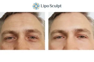 Explaining Total Skin Tightening Treatment And What It Can Do For You 6 Morpheus8 Purfleet book in today to find out more!