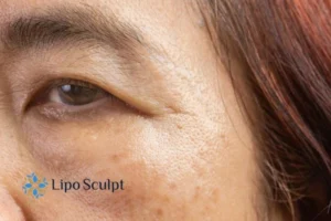 Cryopen: The Revolutionary Treatment for Age Spots Unveiled 2 Are age spots Purfleet giving you low self esteem? Contact us today!