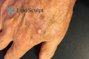 Best Actinic Keratoses Removal 2 Improve your wellbeing and health with Actinic Keratoses Purfleet removal.treatment