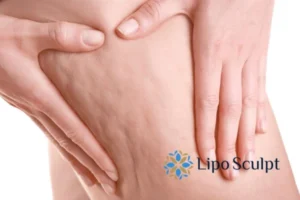 CoolSculpting for Legs: The Innovative Approach to Redefining Your Legs 5 Start your journey today book your coolsculpting treatment Purfleet online today!