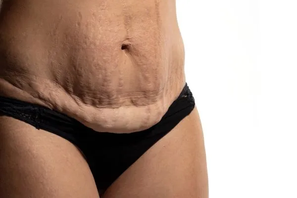 Lost the Weight but Not the Loose Skin? 1 image of womans stomach after weight loss showing loose skin Purfleet